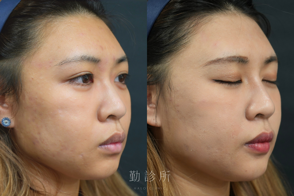 勤診所｜結構式鼻雕案例：右臉