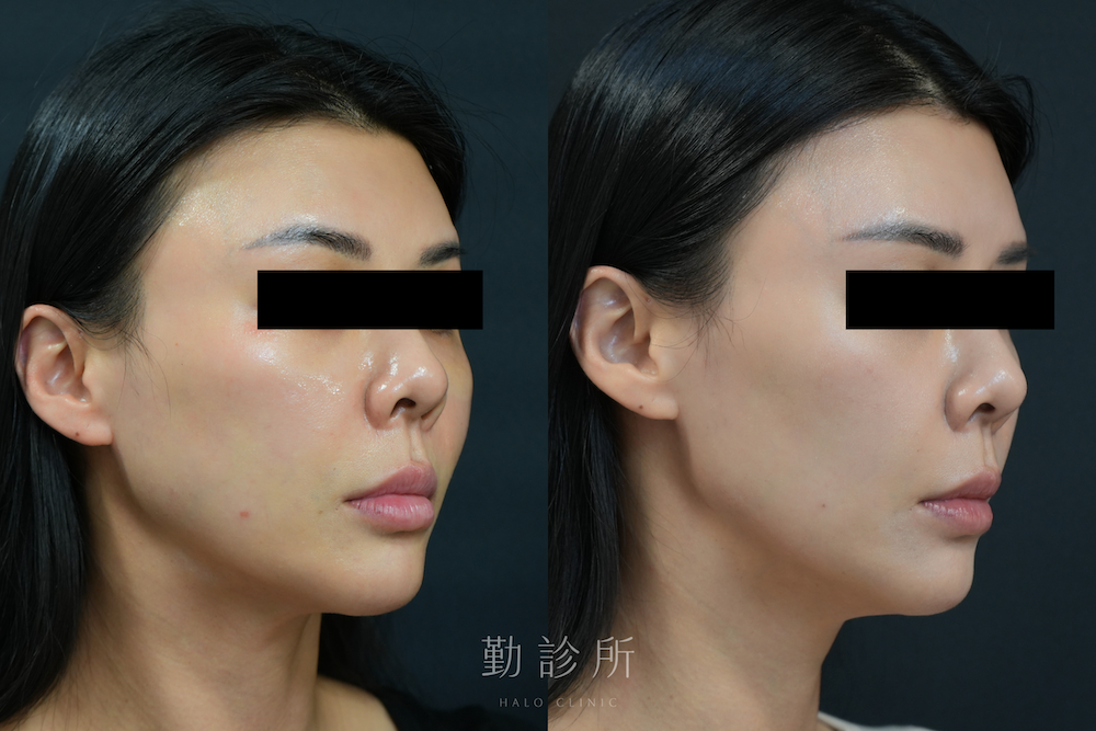 勤診所｜法令紋＋鼻基底填充案例：緹奧希玻尿酸 右臉