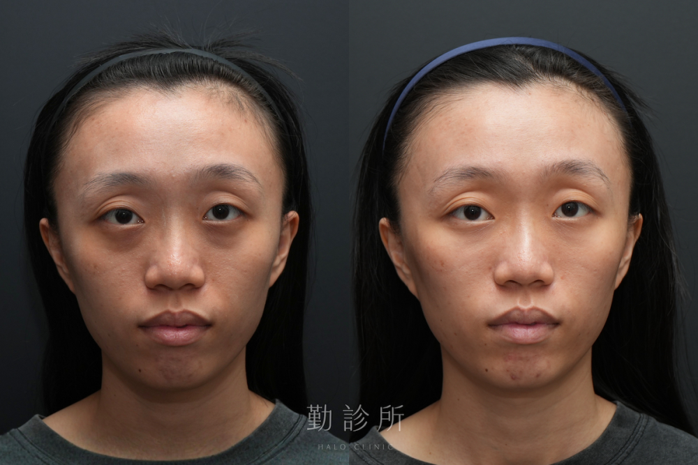 勤診所｜三層式淚溝隱形案例： 正面