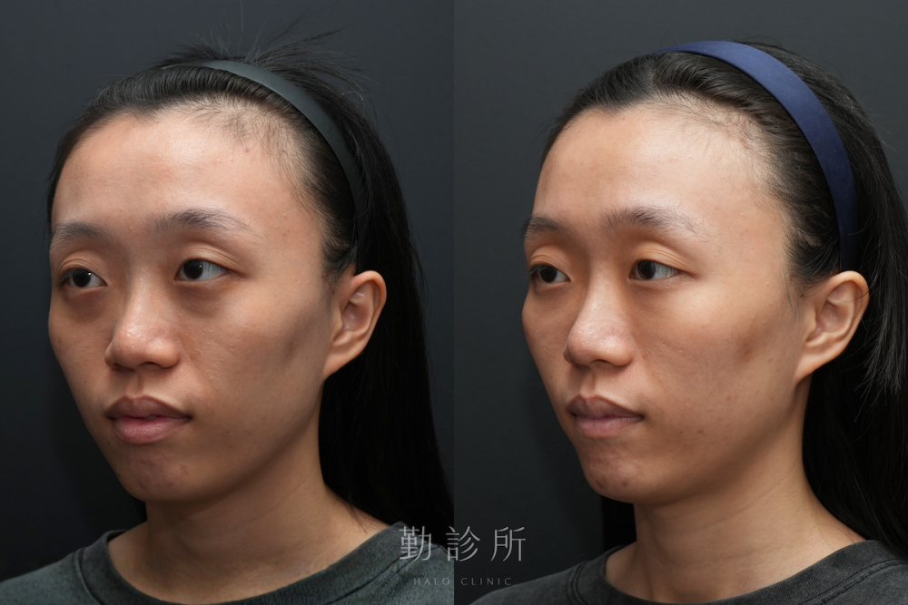 勤診所｜三層式淚溝隱形案例： 左臉