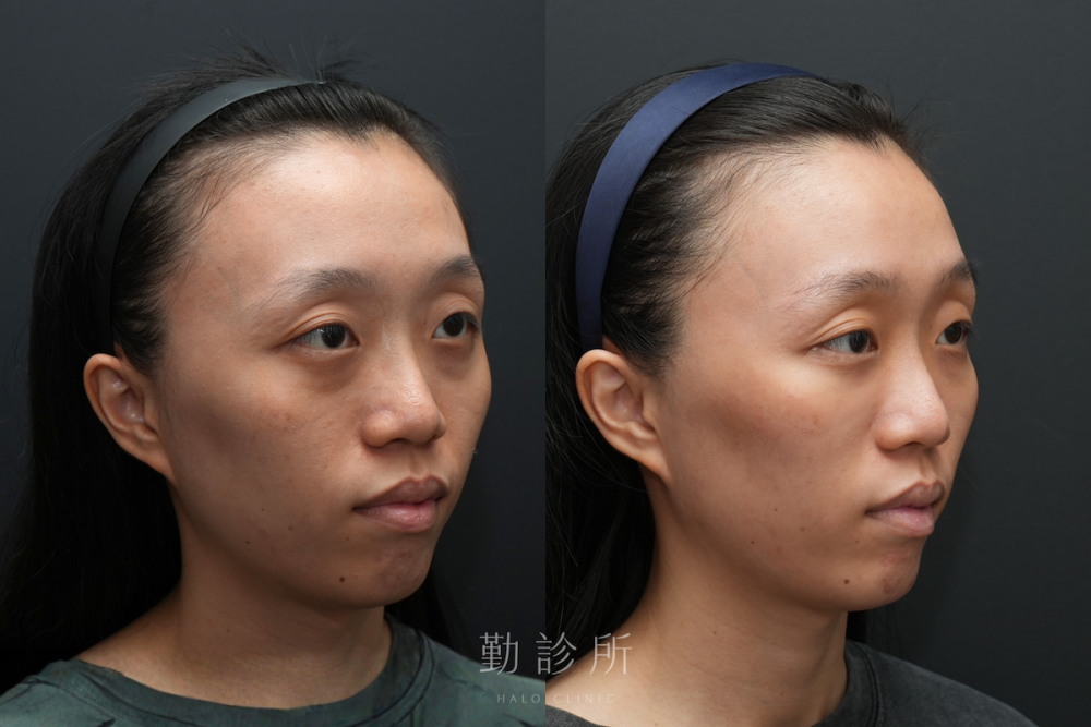 勤診所｜三層式淚溝隱形案例： 右臉