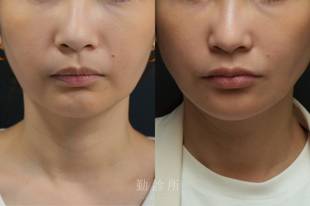 勤診所｜維法熙施打實際案例：正面