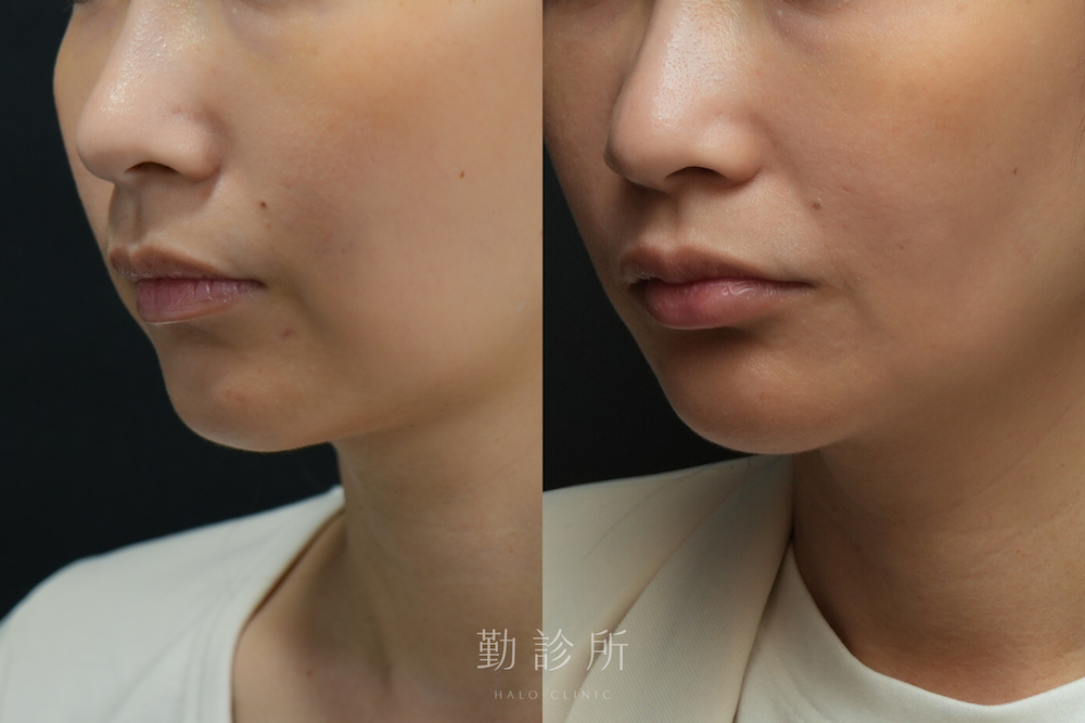 勤診所｜維法熙施打實際案例：左臉