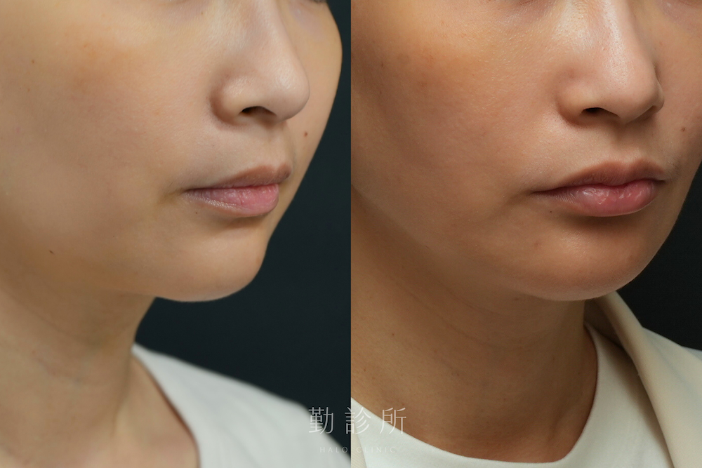 勤診所｜維法熙施打實際案例：右臉