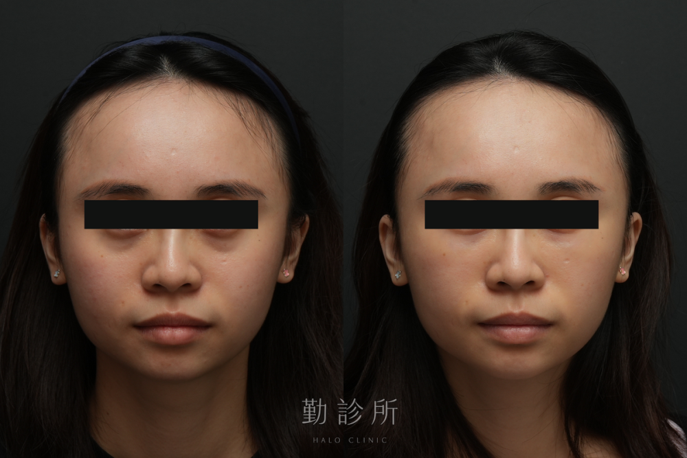 勤診所｜三層式淚溝隱形案例： 正面