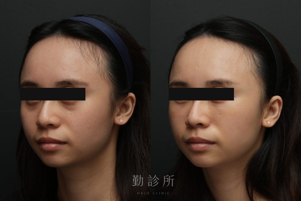 勤診所｜三層式淚溝隱形案例： 左臉