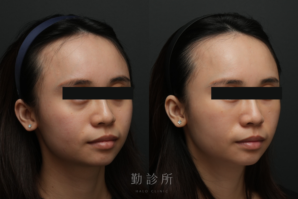 勤診所｜三層式淚溝隱形案例： 右臉