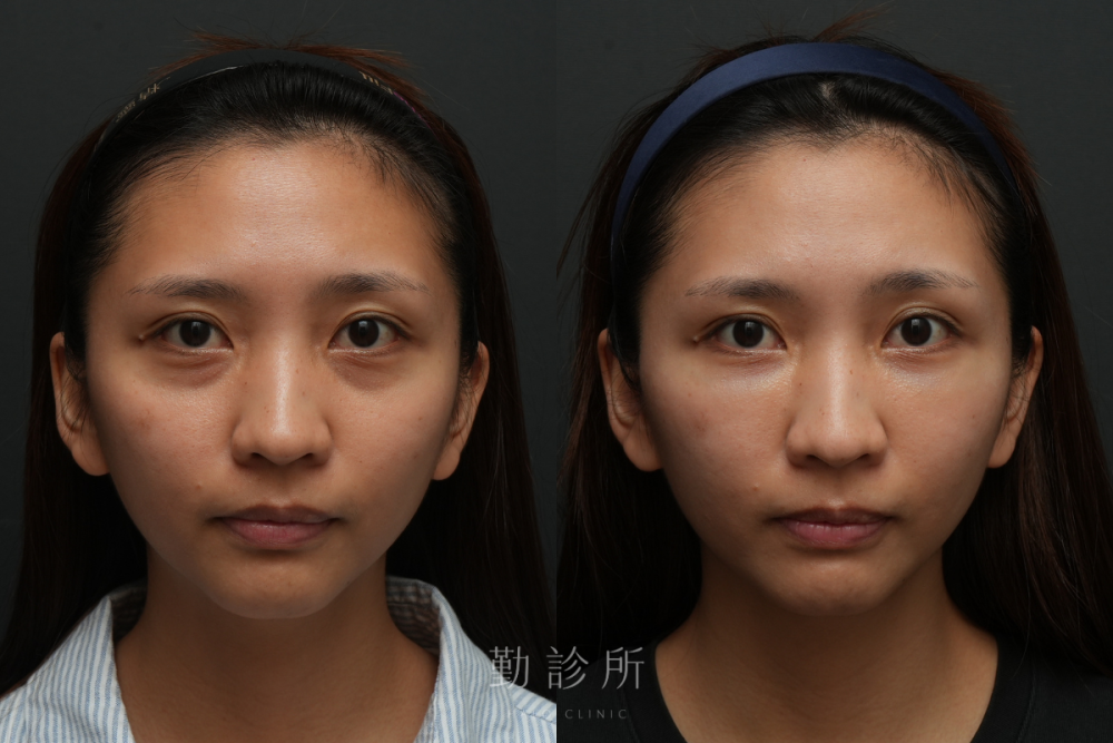 勤診所｜三層式淚溝隱形案例： 正面