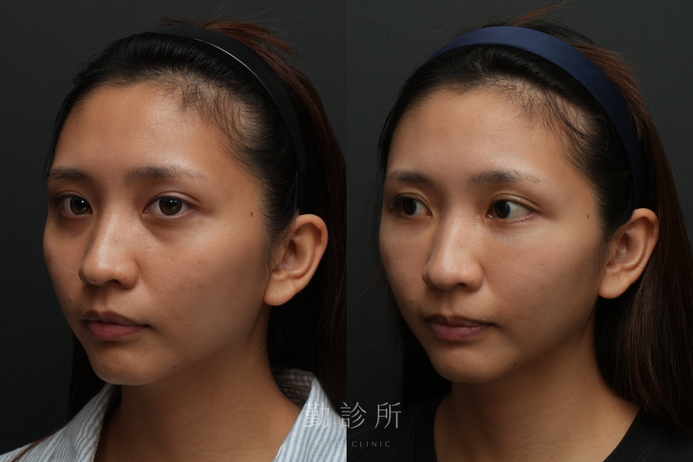 勤診所｜三層式淚溝隱形案例： 左臉