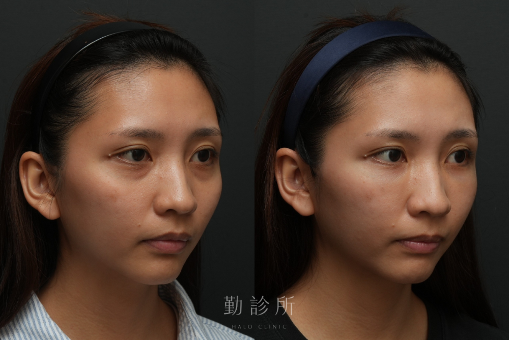 勤診所｜三層式淚溝隱形案例： 右臉