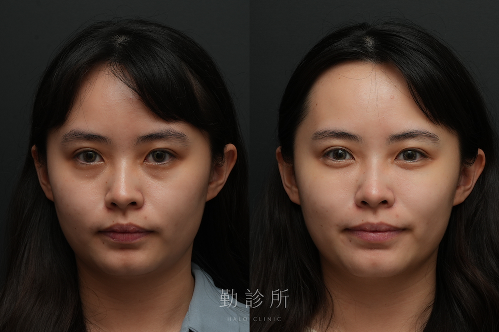 勤診所｜三層式淚溝隱形案例： 正面