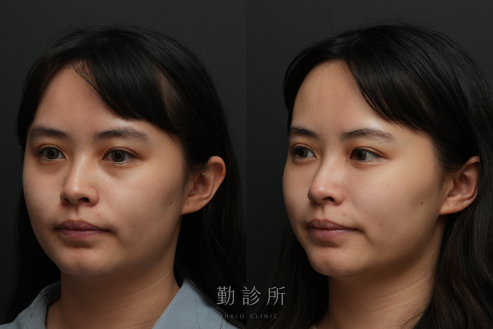 勤診所｜三層式淚溝隱形案例： 左臉