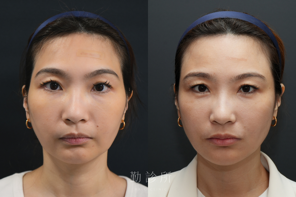 勤診所｜跨層次迴繞拉提案例：中下臉拉提 改善嘴邊肉、清晰輪廓線 正面