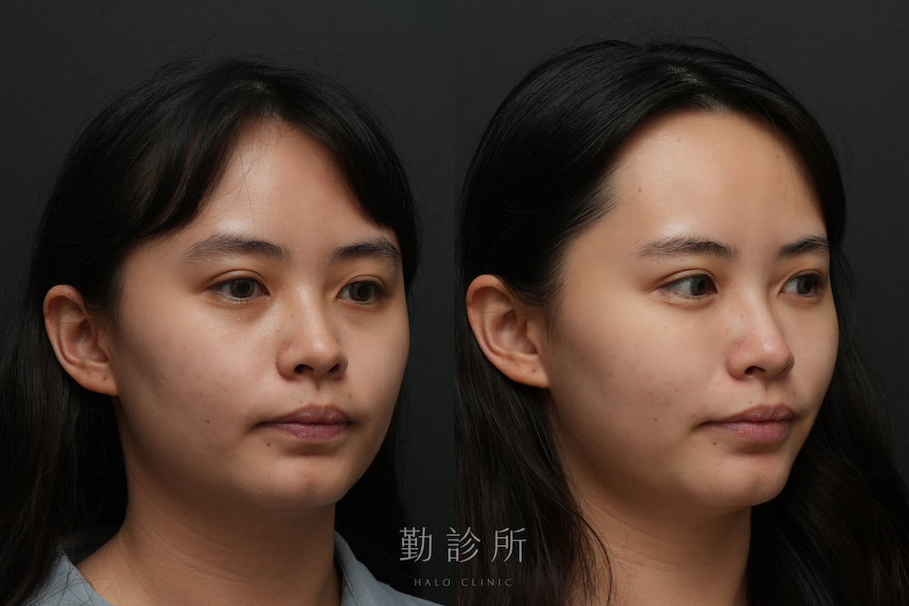 勤診所｜三層式淚溝隱形案例： 右臉