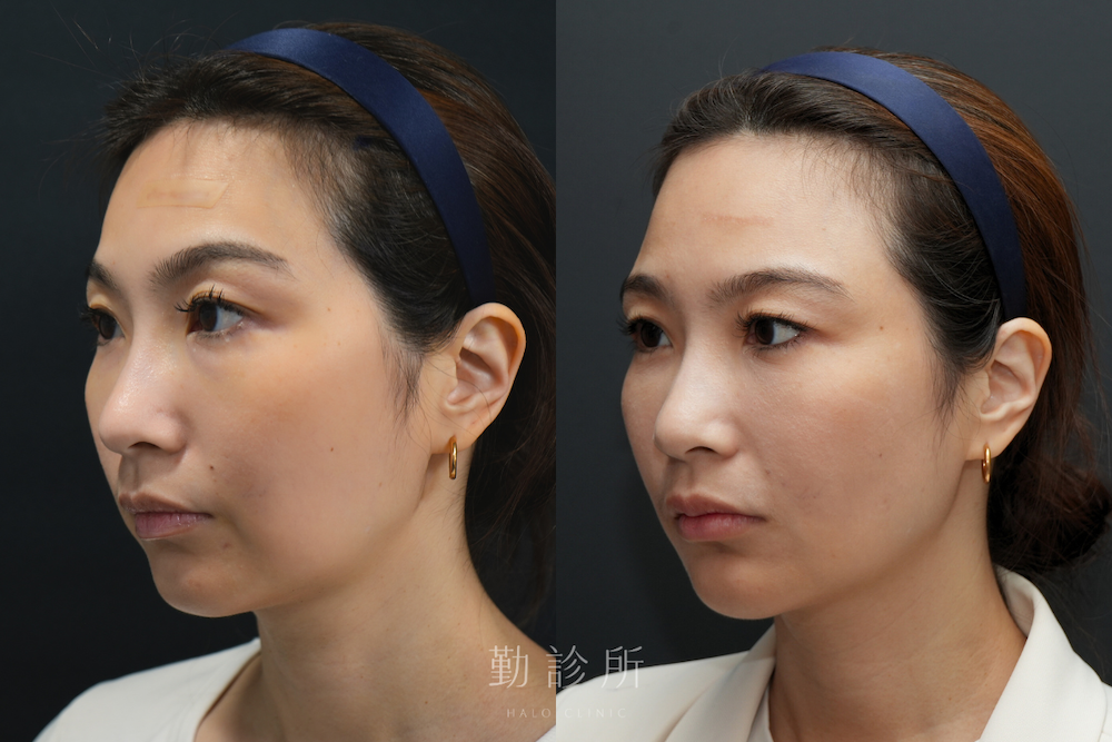 勤診所｜跨層次迴繞拉提案例：中下臉拉提 改善嘴邊肉、清晰輪廓線 左臉