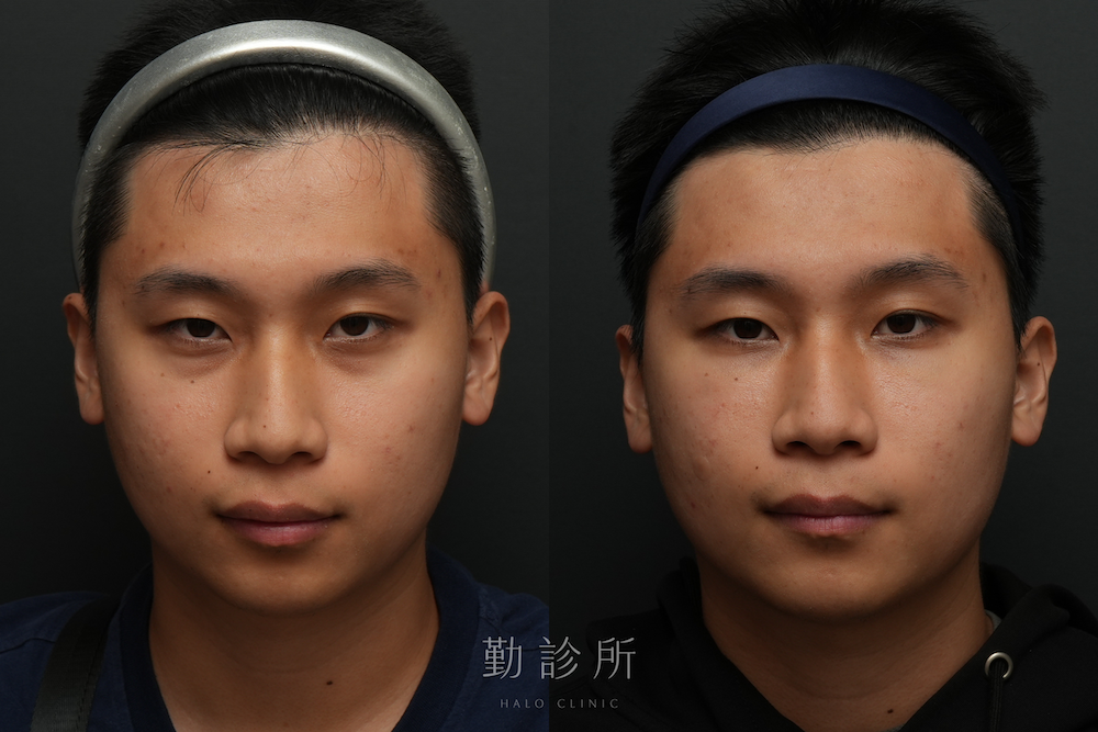 勤診所｜三層式淚溝隱形案例： 正面