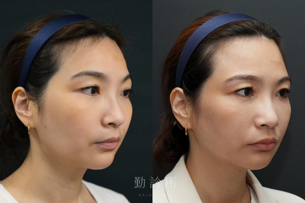 勤診所｜跨層次迴繞拉提案例：中下臉拉提 改善嘴邊肉、清晰輪廓線 右臉
