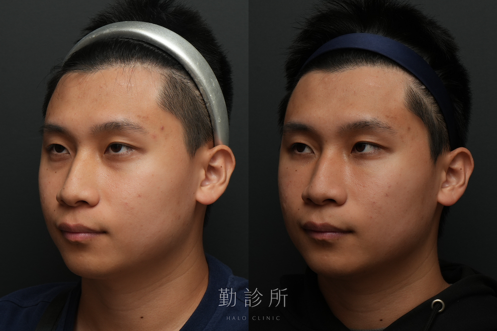 勤診所｜三層式淚溝隱形案例： 左臉