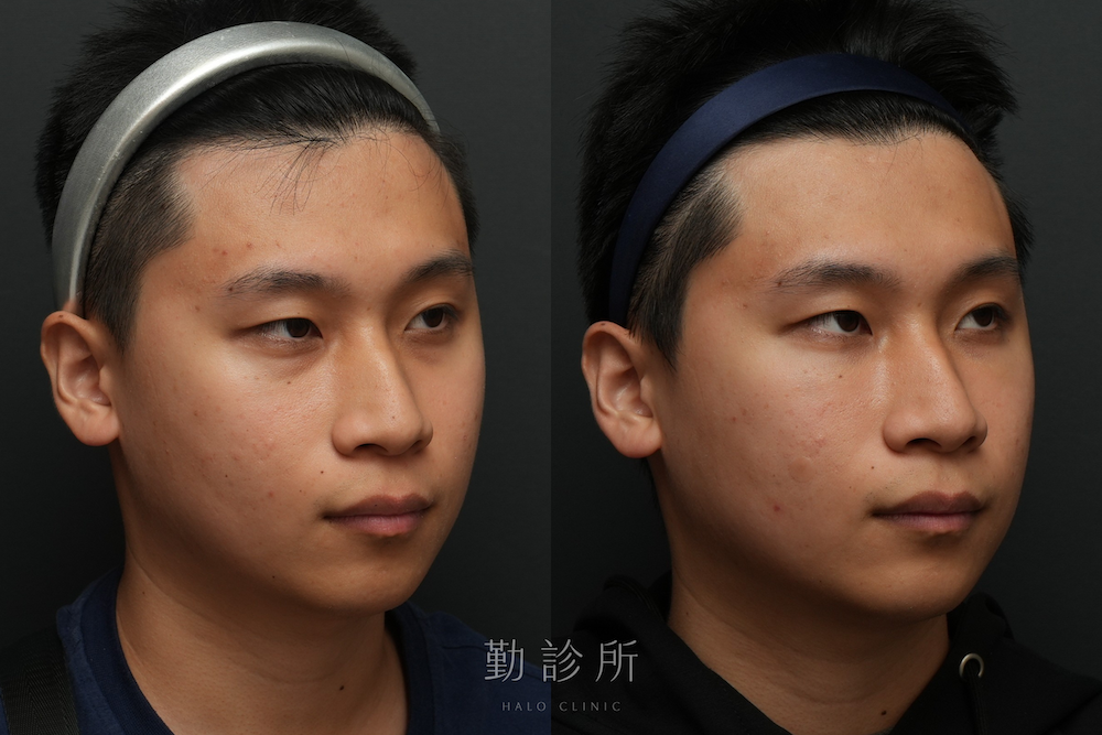 勤診所｜三層式淚溝隱形案例： 右臉