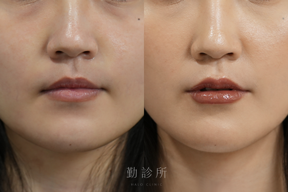 勤診所｜玻尿酸豐唇案例：仙女玻尿酸 正面