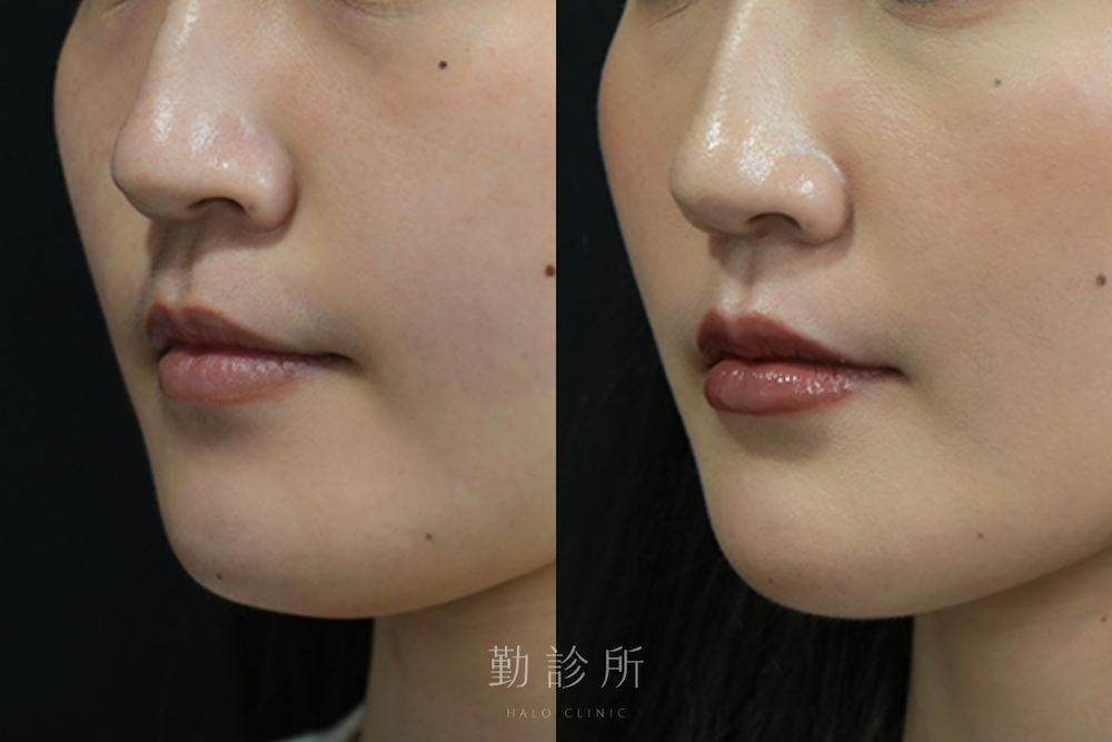 勤診所｜玻尿酸豐唇案例：仙女玻尿酸 左臉