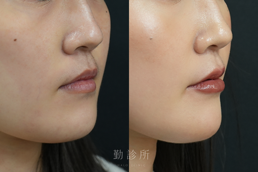 勤診所｜玻尿酸豐唇案例：仙女玻尿酸 右臉