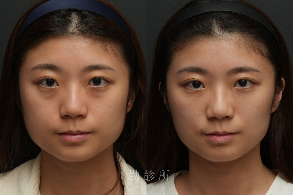 勤診所｜三層式淚溝隱形＋肉毒小臉真實案例： 正臉