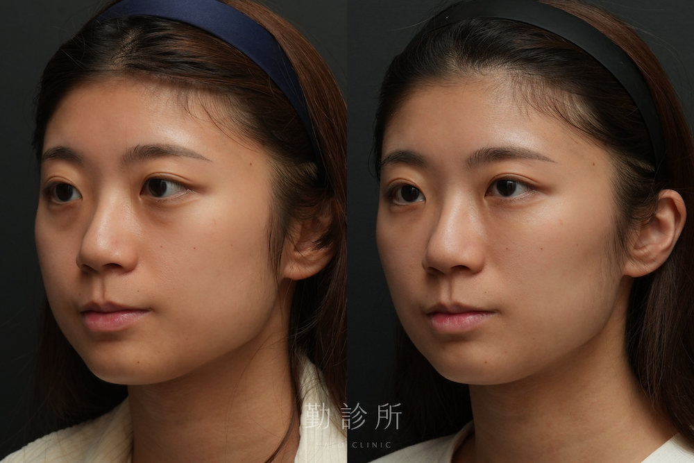 勤診所｜三層式淚溝隱形＋肉毒小臉真實案例： 左臉