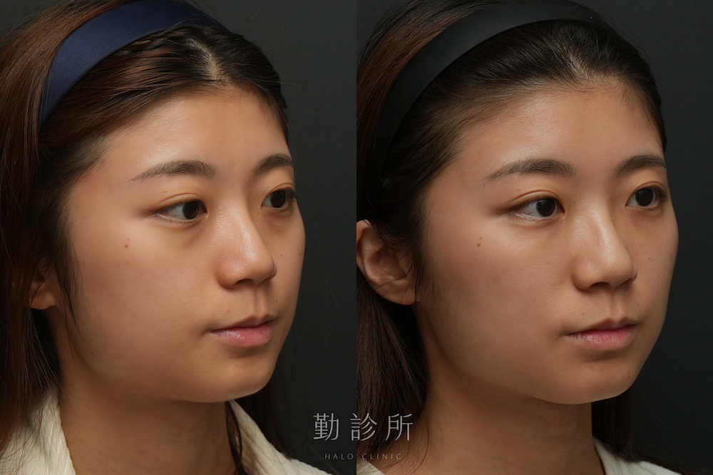 勤勤診所｜三層式淚溝隱形＋肉毒小臉真實案例：右臉