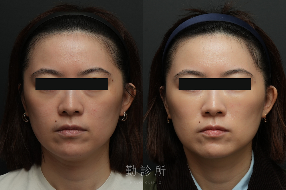 勤診所｜三層式淚溝隱形真實案例：正面