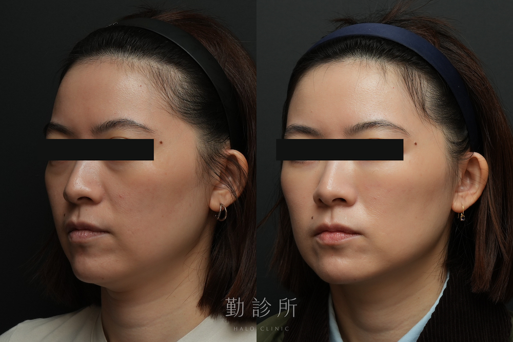 勤診所｜三層式淚溝隱形真實案例：左臉