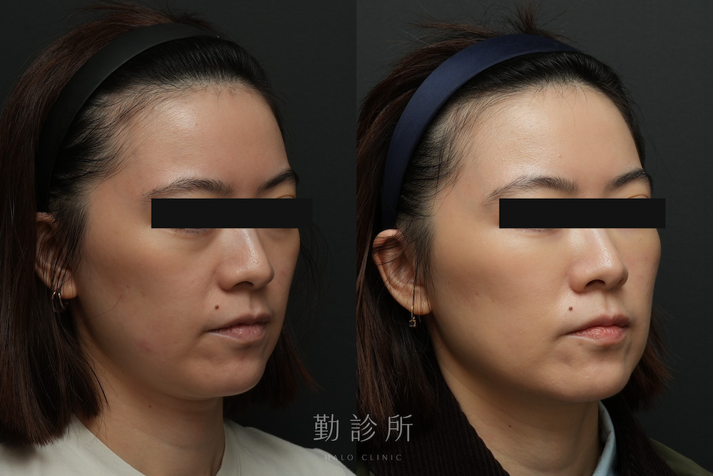 勤診所｜三層式淚溝隱形真實案例：右臉