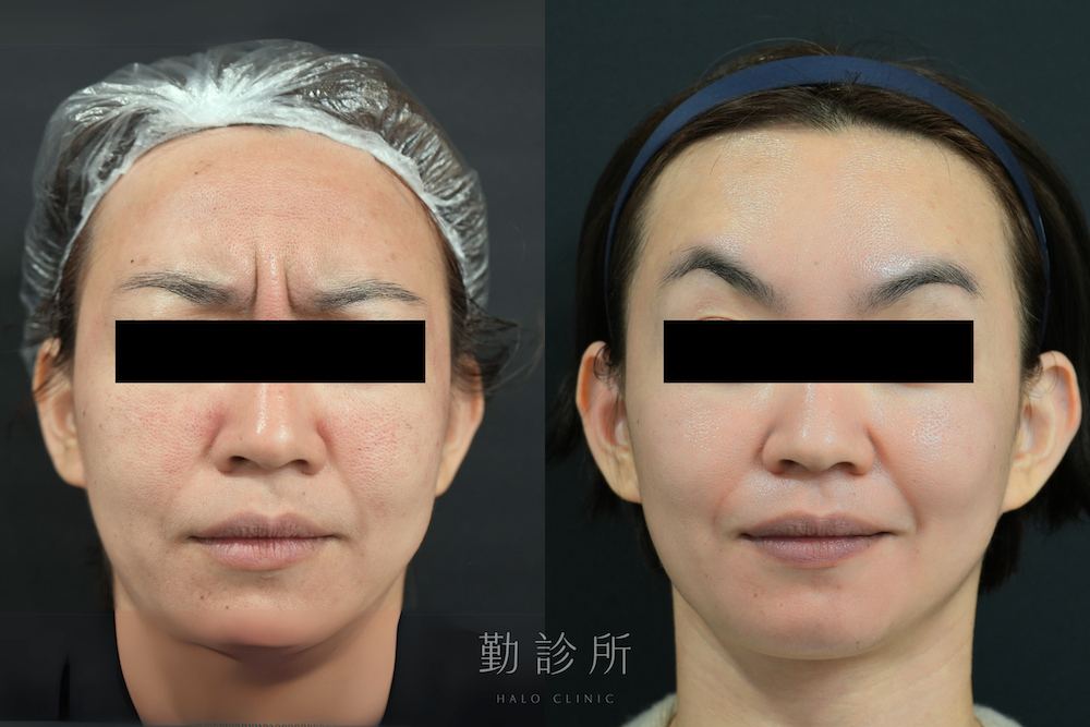 勤診所｜肉毒注射實際案例：肉毒除皺 正面