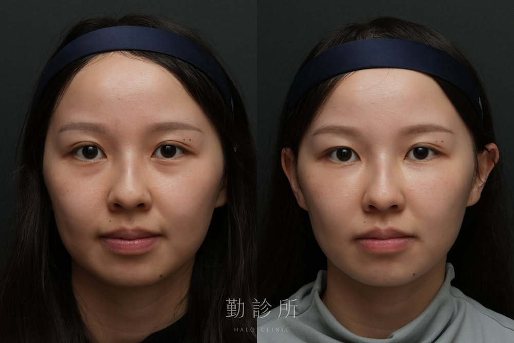 勤診所｜三層式淚溝隱形案例： 正面