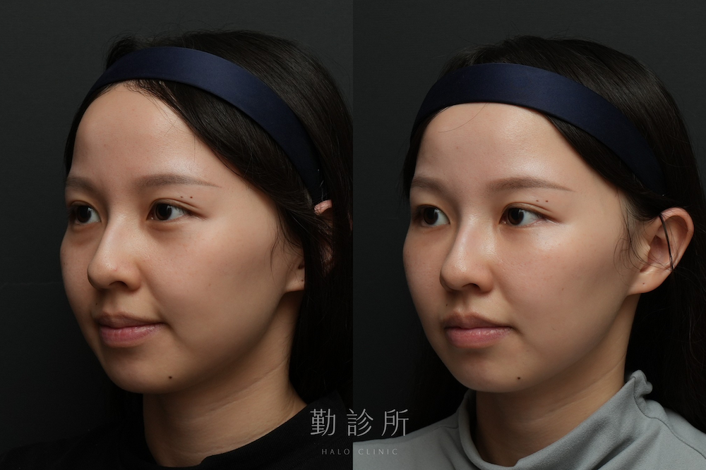 勤診所｜三層式淚溝隱形案例： 左臉
