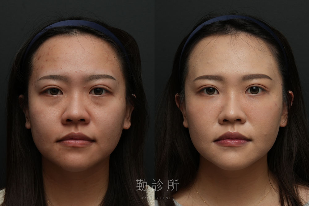 勤診所｜三層式淚溝隱形案例： 正面