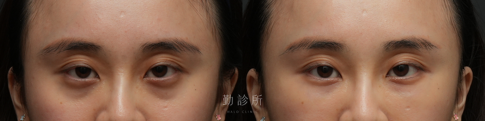 勤診所｜三層式淚溝隱形案例： 正面
