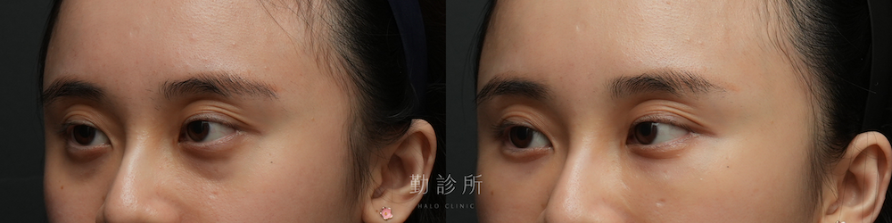 勤診所｜三層式淚溝隱形案例： 左臉