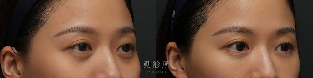 勤診所｜三層式淚溝隱形案例： 右臉