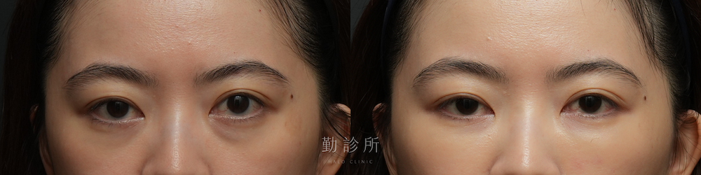 勤診所｜三層式淚溝隱形案例： 正面