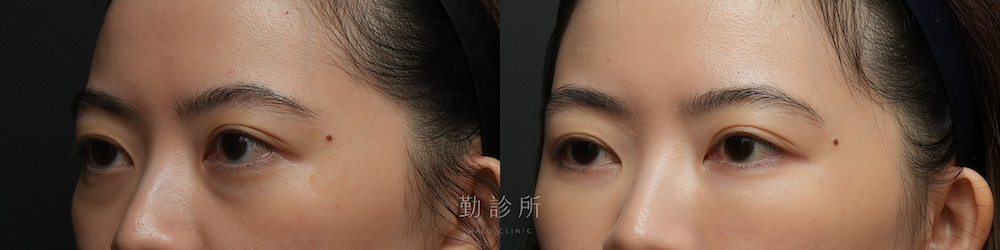 勤診所｜三層式淚溝隱形案例： 左臉