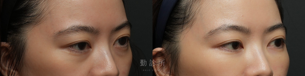 勤診所｜三層式淚溝隱形案例： 右臉