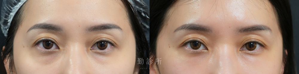 勤診所｜三層式淚溝隱形案例： 正面