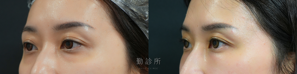 勤診所｜三層式淚溝隱形案例： 左臉