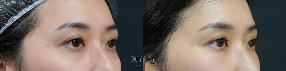 勤診所｜三層式淚溝隱形案例： 右臉