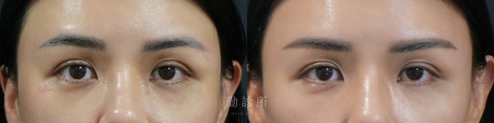 勤診所｜三層式淚溝隱形案例： 正面