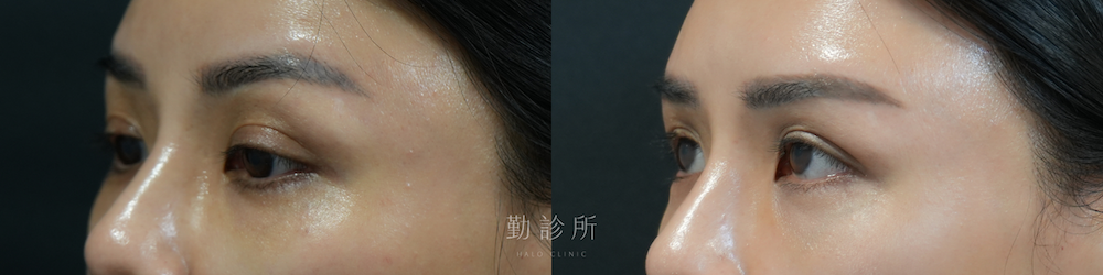 勤診所｜三層式淚溝隱形案例： 左臉