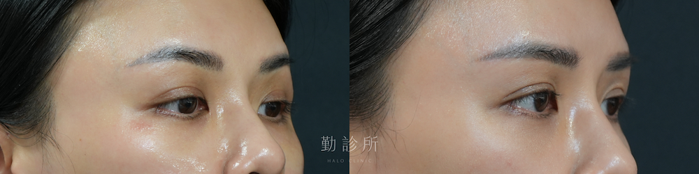 勤診所｜三層式淚溝隱形案例： 右臉