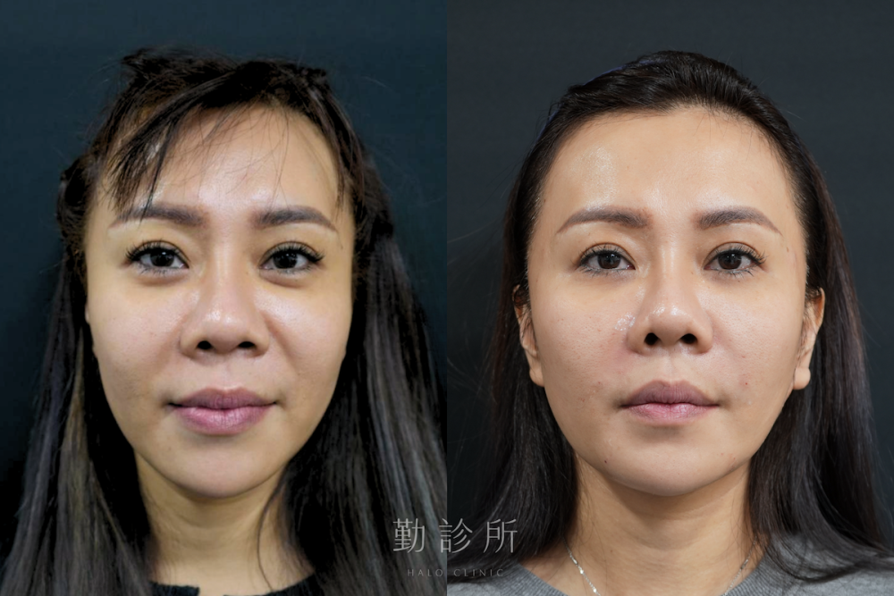 勤診所｜跨層次迴繞拉提案例：中臉拉提改善法令紋 正面