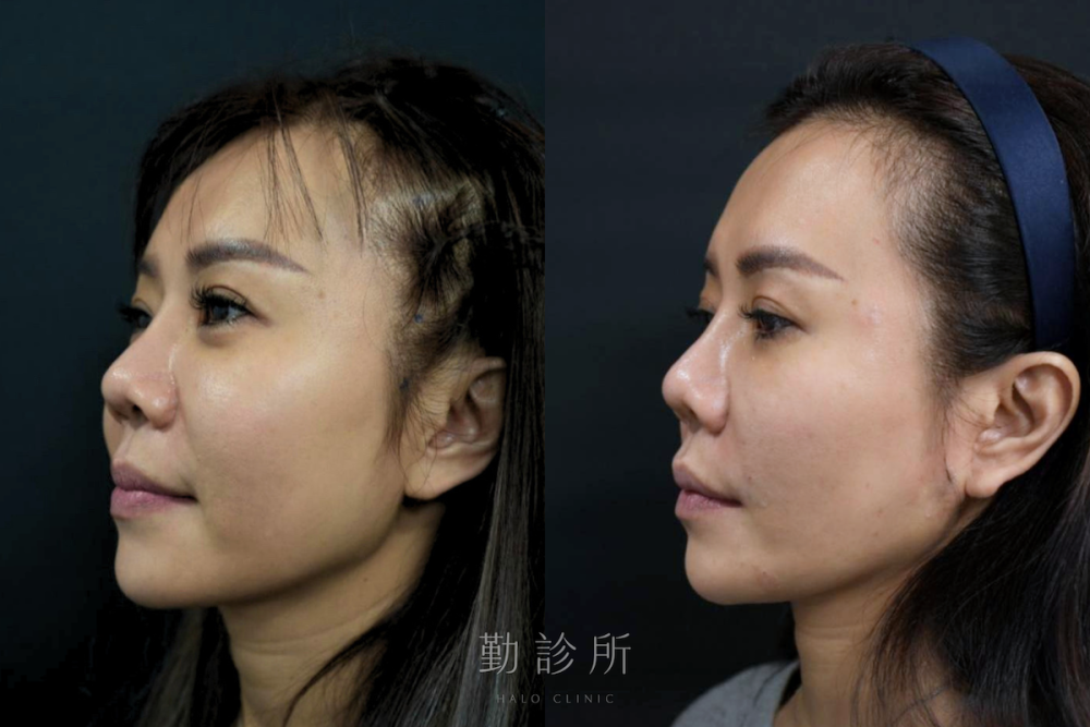 勤診所｜跨層次迴繞拉提案例：中臉拉提改善法令紋 左臉
